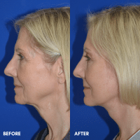 FMPS B&A Template - Lower face and neck lift