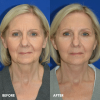 FMPS B&A Template - lower face and neck lift