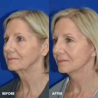 FMPS B&A Template - lower face and neck lift