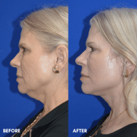 FMPS B&A Template - lower face and neck lift (3) FMPS B&A Template - lower face and neck lift (3)