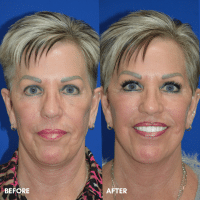 FMPS B&A Template - lower face and neck lift
