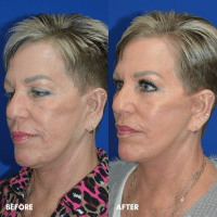 FMPS B&A Template - lower face and neck lift