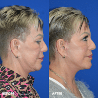 FMPS B&A Template - lower face and neck lift