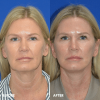 FMPS B&A Template - lower face and neck lift