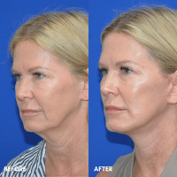 FMPS B&A Template - lower face and neck lift
