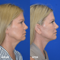 FMPS B&A Template - lower face and neck lift