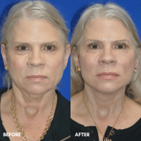 FMPS B&A Template - lower face and neck lift