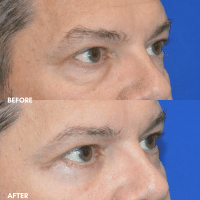 OLD FMPS B&A Template - lower blepharoplasty (2)