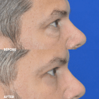 OLD FMPS B&A Template - lower blepharoplasty (3) OLD FMPS B&A Template - lower blepharoplasty (3)