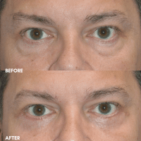 OLD FMPS B&A Template - lower blepharoplasty