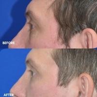 FMPS/CFPS B&A Templates  - Lower Bleph/ Tear trough Sanderson