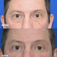FMPS/CFPS B&A Templates  - Lower Bleph/ Tear trough Sanderson