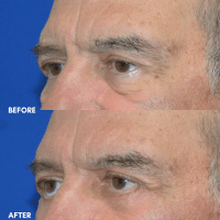 FMPS B&A Template - lower bleph
