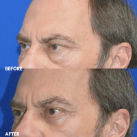 OLD FMPS B&A Template - lower blepharoplasty (2)