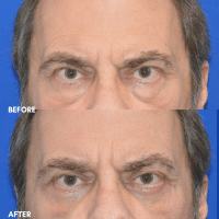 OLD FMPS B&A Template - lower blepharoplasty (3)