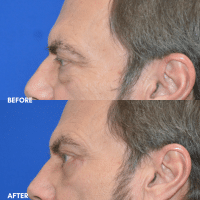 OLD FMPS B&A Template - lower blepharoplasty