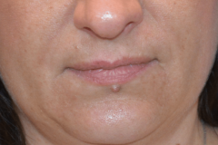 Lip-Implants-Before