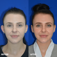 OLD FMPS B&A Template -  otoplasty OLD FMPS B&A Template -  otoplasty