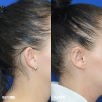 OLD FMPS B&A Template - otoplasty OLD FMPS B&A Template - otoplasty