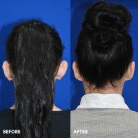 OLD FMPS B&A Template - otoplasty (2) OLD FMPS B&A Template - otoplasty (2)