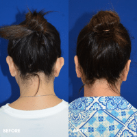 FMPS B&A Template - otoplasty