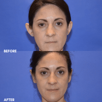 FMPS B&A Template - otoplasty