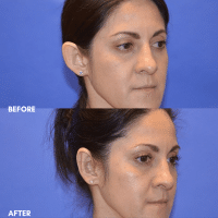 FMPS B&A Template - otoplasty