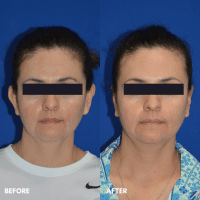 FMPS B&A Template - otoplasty