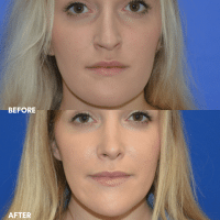 FMPS B&A Template - chin reduction and rhinoplasty