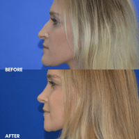FMPS B&A Template - chin reduction and rhinoplasty