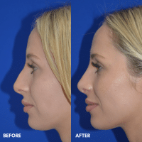OLD FMPS B&A Template - rhinoplasty (2) OLD FMPS B&A Template - rhinoplasty (2)