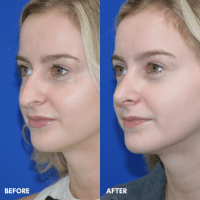 OLD FMPS B&A Template - rhinoplasty (3) OLD FMPS B&A Template - rhinoplasty (3)