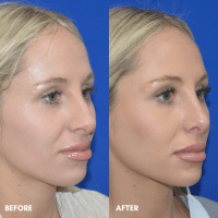 OLD FMPS B&A Template - rhinoplasty