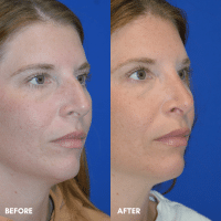 OLD FMPS B&A Template - rhinoplasty- patient 01- 1 OLD FMPS B&A Template - rhinoplasty- patient 01- 1