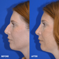 OLD FMPS B&A Template - rhinoplasty- patient 01- 2