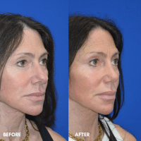 OLD FMPS B&A Template- Sanderson & Braswell Patients - 2025-10-03-rhinoplasty-01 (2) OLD FMPS B&A Template- Sanderson & Braswell Patients - 2025-10-03-rhinoplasty-01 (2)