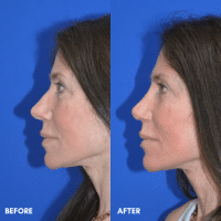 OLD FMPS B&A Template- Sanderson & Braswell Patients - 2025-10-03-rhinoplasty-01 (3) OLD FMPS B&A Template- Sanderson & Braswell Patients - 2025-10-03-rhinoplasty-01 (3)
