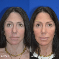 OLD FMPS B&A Template- Sanderson & Braswell Patients - 2025-10-03-rhinoplasty-01 OLD FMPS B&A Template- Sanderson & Braswell Patients - 2025-10-03-rhinoplasty-01