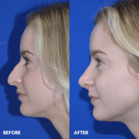OLD FMPS B&A Template - rhinoplasty (2) OLD FMPS B&A Template - rhinoplasty (2)