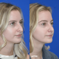 OLD FMPS B&A Template - rhinoplasty