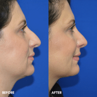 FMPS B&A Template - Rhinoplasty 2