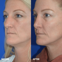 FMPS B&A Template - rhinoplasty