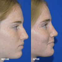 FMPS B&A Template - rhinoplasty