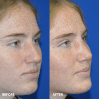 FMPS B&A Template - rhinoplasty