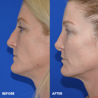 FMPS B&A Template - rhinoplasty
