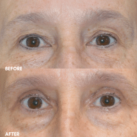 OLD FMPS B&A Template- Sanderson & Braswell Patients - 2025-09-18-upperbleph-01.png