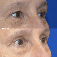 OLD FMPS B&A Template- Sanderson & Braswell Patients - 2025-09-18-upperbleph-02 OLD FMPS B&A Template- Sanderson & Braswell Patients - 2025-09-18-upperbleph-02