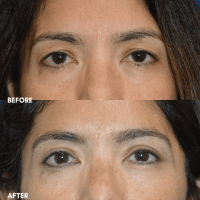 OLD FMPS B&A Template- Sanderson & Braswell Patients - 2025-11-24-upperbleph-01